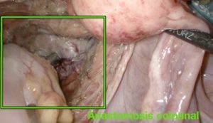 Anastomosis coloanal en cáncer de recto bajo